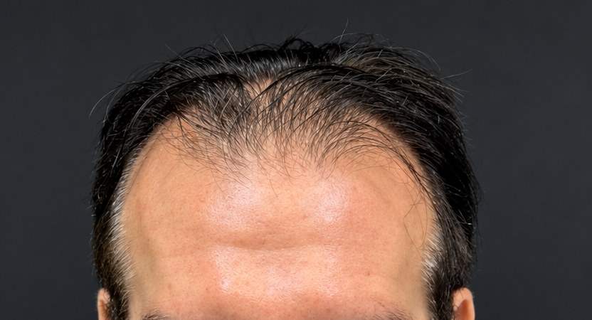 Antes